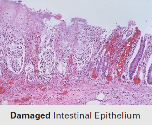 Microscopic image of intestinal epithelium showing tissue damage, with irregular structure, cell loss, and areas of red inflammation. The text below reads "Damaged Intestinal Epithelium.